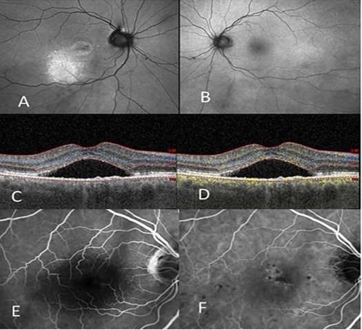 (A) Left shows autofluorescent changes, central and inferior, of the right eye. (B) Autofluorescent changes in the left eye which are much milder. (C) OCT right eye shows the thick choroid and serous detachment of the macula. (D) OCTA shows pachychoroid, double layer sign with neovascularization and serous detachment of the macula of the left eye. (E) IVFA of the right eye shows hypofluorescence from the subretinal fluid, however there are no leakage sites. (F) ICG of the right eye shows hyperfluorescence centrally and peripherally.