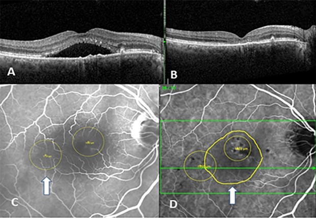 (A) right eye OCT showing thick choroid, “double layer” sign, and serous detachment of the macula (B) right eye, s/p ICG and OCTA targeted PDT Triple Therapy (C) shows the IVFA targets (D) shows the ICG image revealing the two PDT targets with mapping of serous detachment (white arrow).