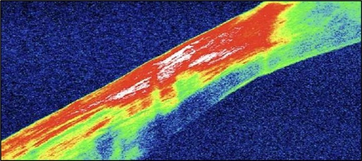 (6 months follow-up): OCT demonstrates complete structural restoration of the cornea with a smooth anterior contour, full re-epithelialization, and resolution of the ulcer defect. Mild residual stromal hyperreflectivity remains, consistent with fibrotic scarring. There is no evidence of epithelial breakdown or recurrence, indicative of a quiescent disease state