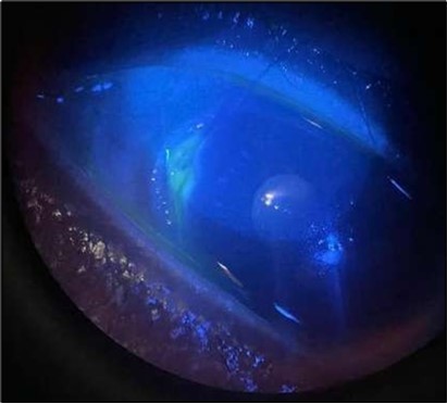 OS, Fluorescein-stained slit-lamp image: positive uptake at site of epithelial defect.