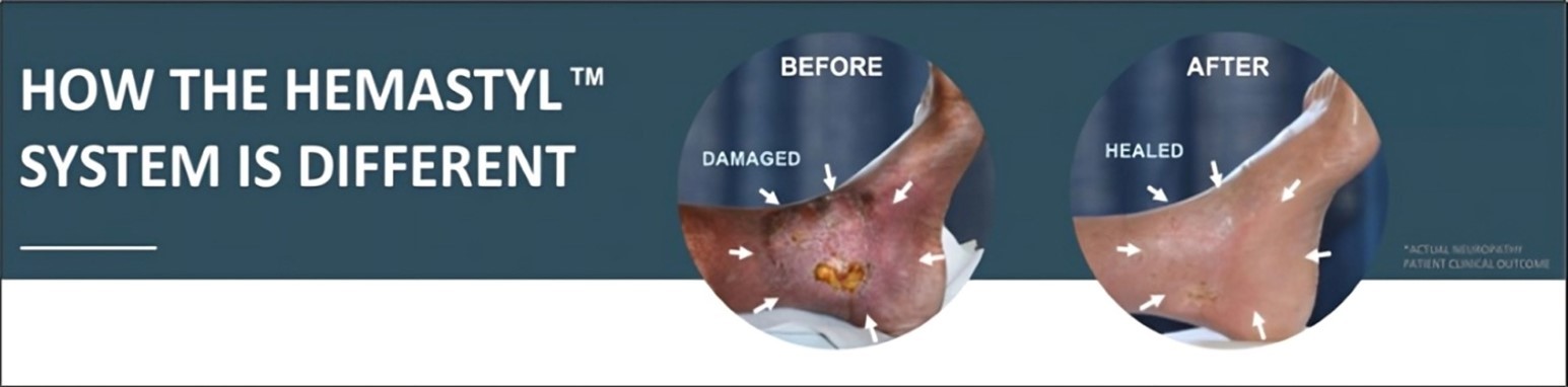 The above patient was diagnosed for an amputation but did not schedule his amputation and enrolled in our feasibility study instead. His previous treatment consisted of the current standard of care which was ineffective in healing his leg and wound. Hemastyl™ System is a dual action product, healing neuropathy while eliminating harmful microbes.