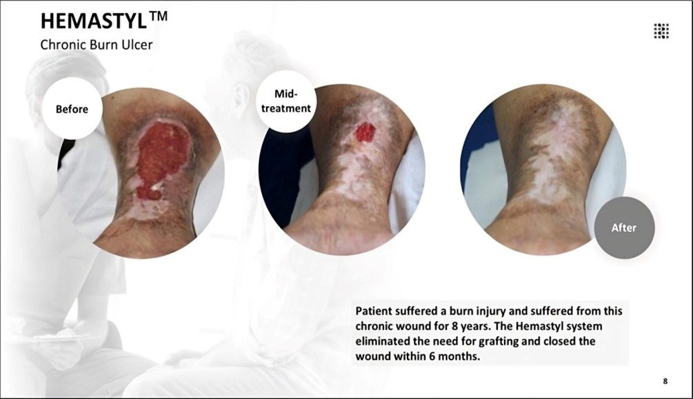 The patient suffered a burn injury and suffered from this chronic wound for 8 years. The Hemastyl™ System eliminated the need for grafting and closed the wound within 6 months.