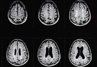 International Journal of Multiple Sclerosis and  Related Disorders